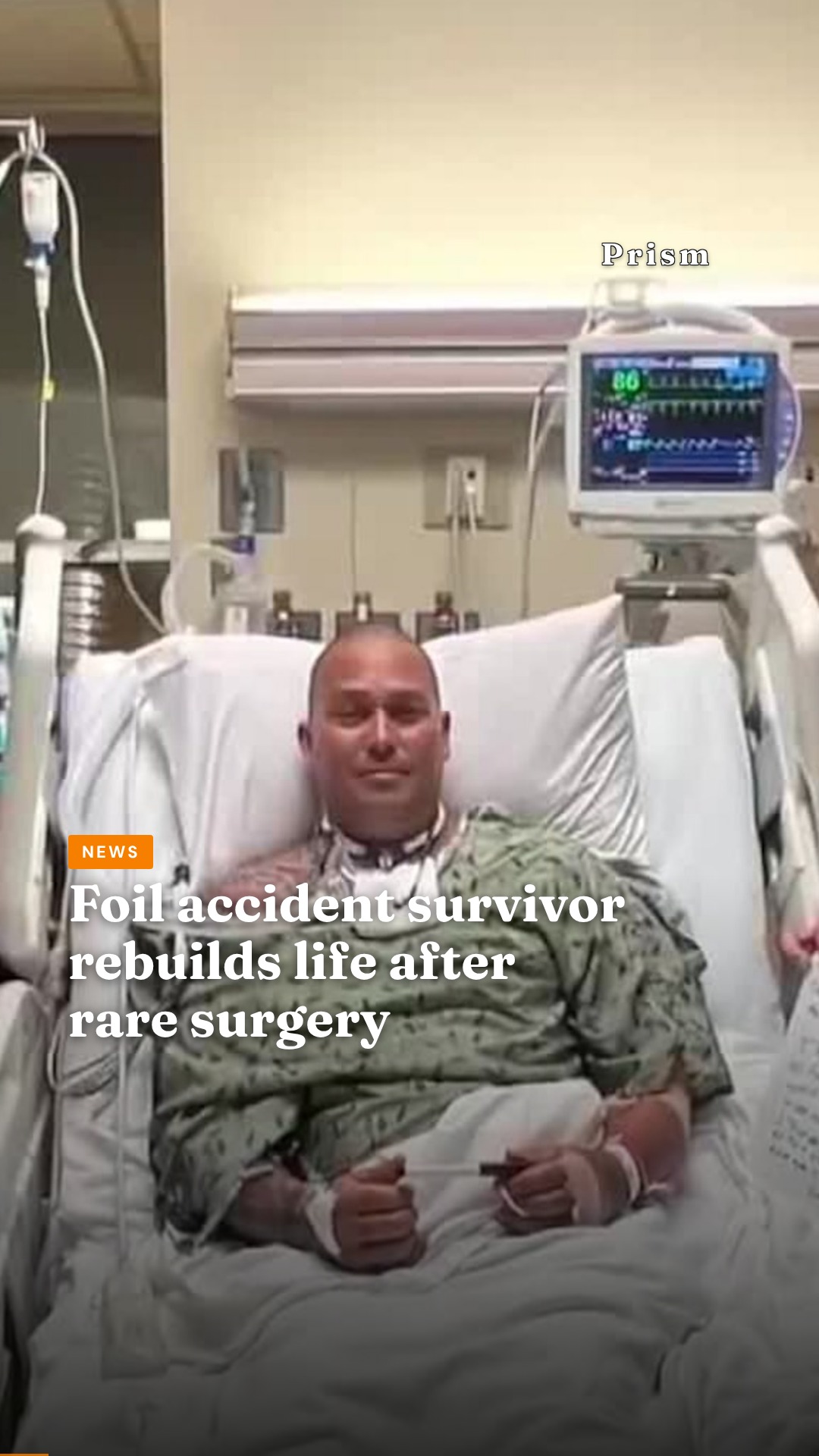 Foil accident survivor rebuilds life after rare surgery